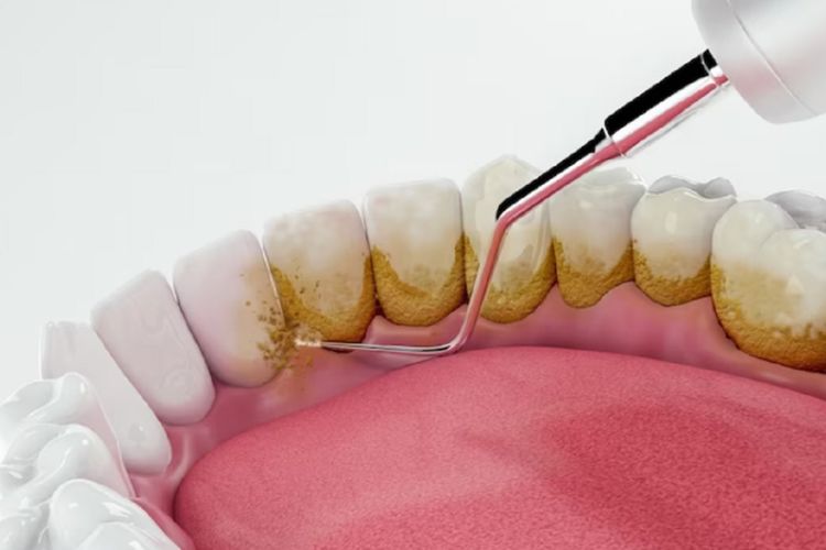 Senyum Manis Tertahan Karena Malu Ada Karang Gigi? Ini 5 Cara Ampuh Menghilangkannya