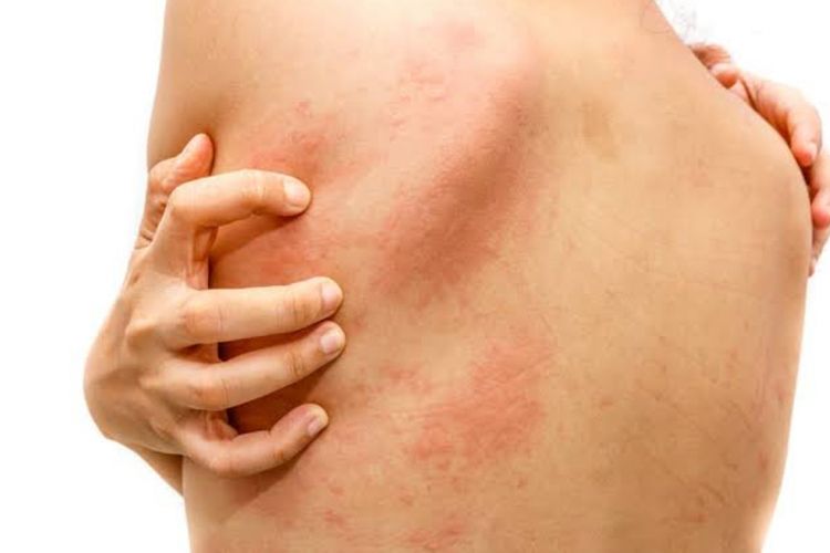 Stevens Johnson Syndrome (SJS): Mengenali Gejala Awal Ruam Kulit yang Berbahaya