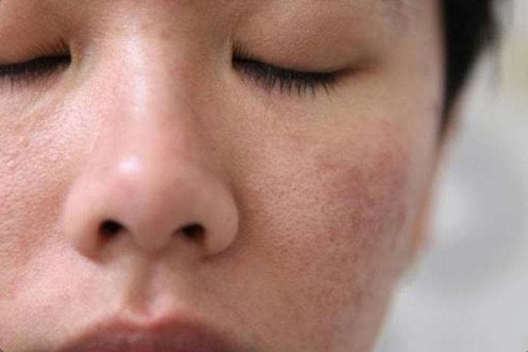 Rahasia Kulit Sehat: Ikuti 6 Cara Memperbaiki Skin Barrier Ini