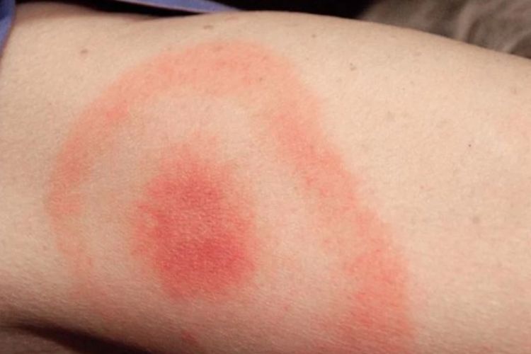 Mengenal Lebih Dekat Penyakit Lyme, Kondisi yang Dialami Supermodel Bella Hadid