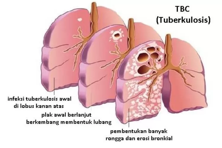 Gejala, Penyebab, dan Cara Mengobati Tuberkulosis (TBC) - Harian Haluan