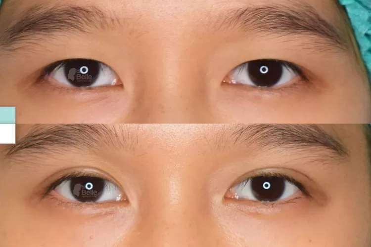 Apa itu shop double eyelid