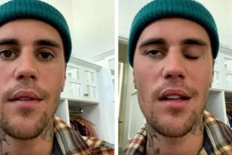 Justin Bieber Alami Sindrom Ramsay Hunt, Konser Di AS Batal Di ...