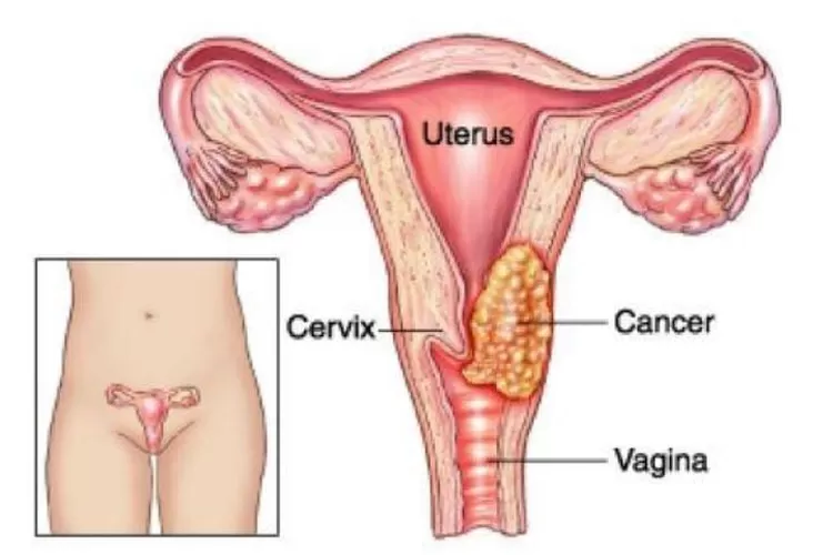 Kenali 15 ciri kemunculan Kanker Serviks pada wanita yang perlu dikenali sejak dini, salah satunya adalah perubahan siklus menstruasi