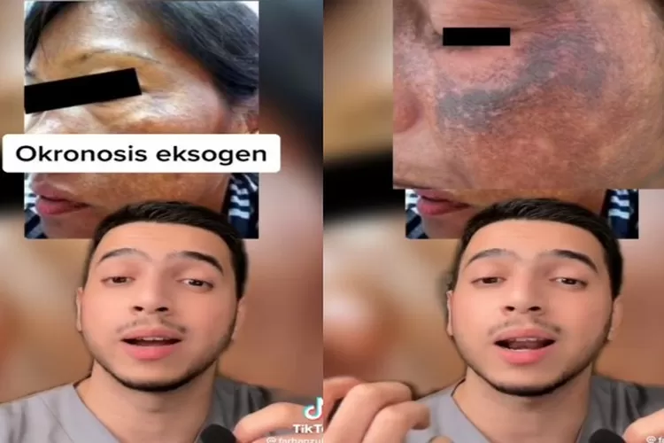 Apakah Okronosis? dan Tips Agar Tidak Terjebak Krim Abal-Abal: Warna