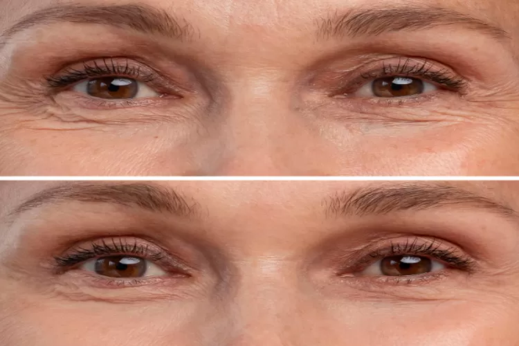 Kerutan dibawah mata yang terjadi pada manusia memasuki usia 40 tahun (Freepik)