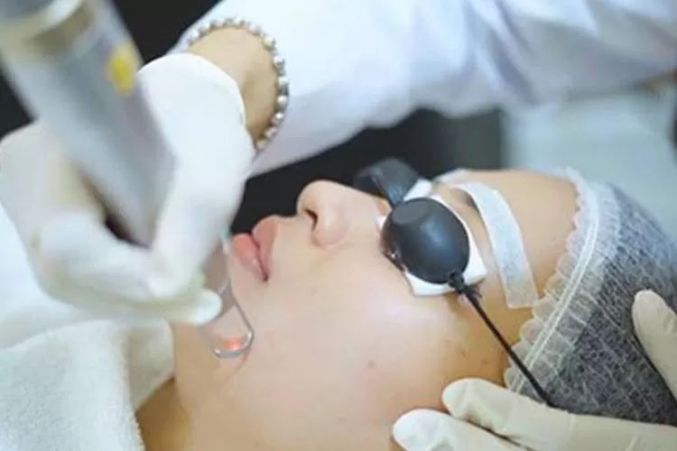 Pico Laser: Solusi Terjangkau untuk Mengatasi Bekas Jerawat tanpa Perlu Mahal