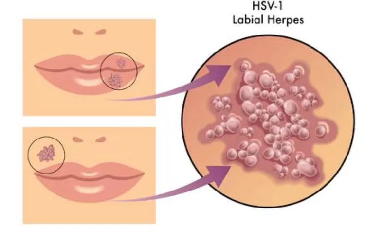 Herpes Gejala Penyebab Dan Pengobatannya Indozone Health