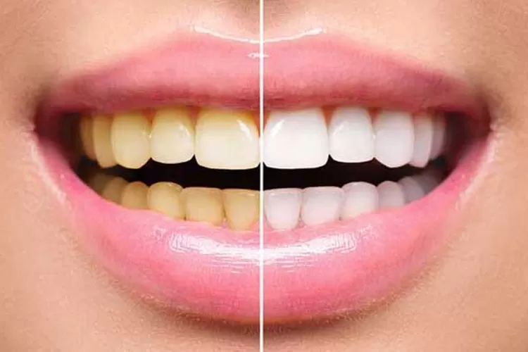 Raih Senyum Menawan dengan 5 Tips Rumahan agar Gigi Lebih Putih - Jawa Pos