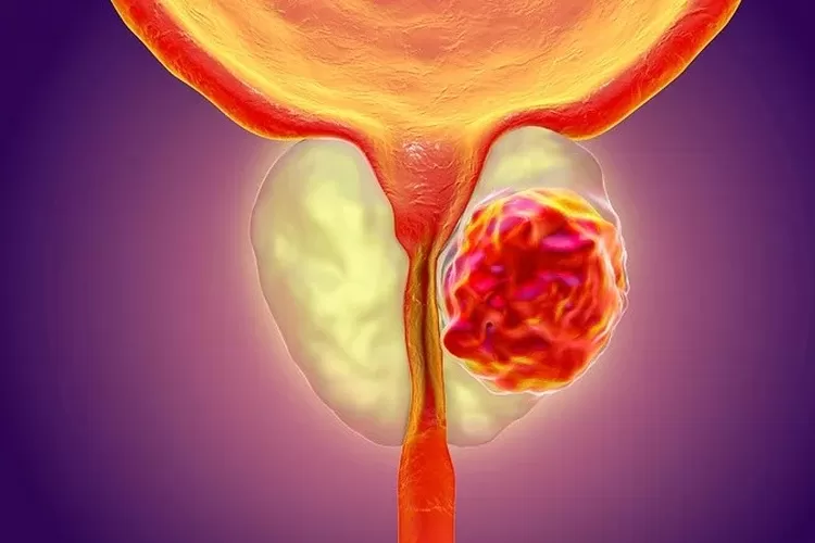 Understanding Prostate Cancer: Symptoms, Causes, and Treatments