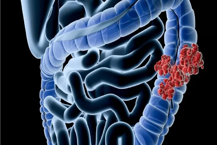 Ilustrasi kanker usus besar.  (Foto: healtheuropa.eu)