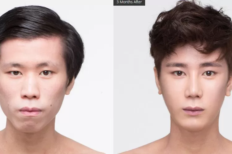 5 Foto Before-after Operasi Plastik Di Korea Yang Bikin Melongo, Hasil ...