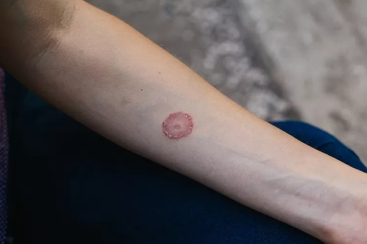 Jenis Infeksi Jamur Kulit Ringworm Nawacita Post