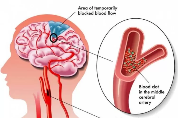 Jangan Sampai Menyesal! Kurangi Faktor Risiko Stroke dengan Gaya Hidup Sehat, Berikut Macam-Macam Asupan Nutrisi yang Harus Diperbanyak dan Dibatasi (Dok. ayosehat.kemkes.go.id)