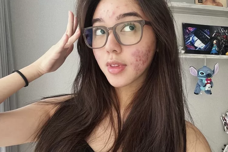 Gabriella Ekaputri Tampil Percaya Diri Meski Wajah Berjerawat (instagram @gabrielaekaputri)