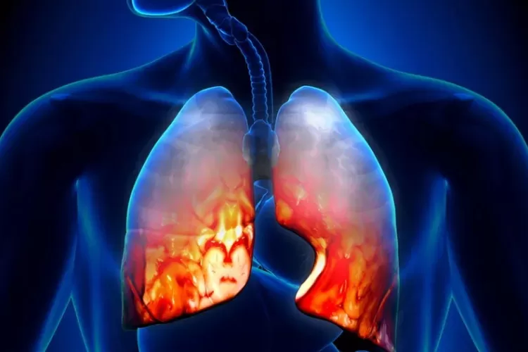 Ilustrasi TBC (SM Purbalingga/dok RA UNS)