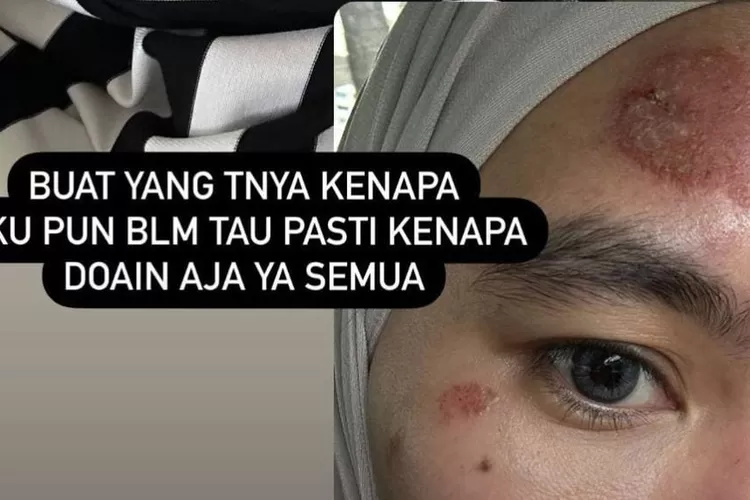 Kartika Putri Sakit (Instagram @kartikaputriworld)