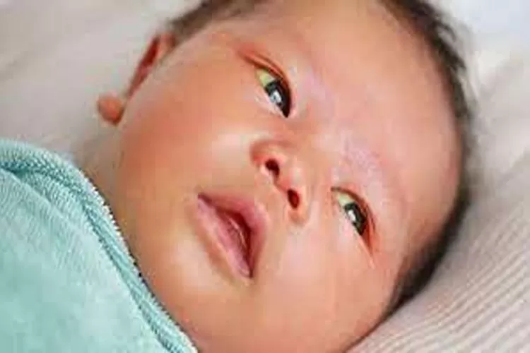 Penyakit Kuning Yang Sering Terjadi Pada Bayi Baru Lahir  (Isti)