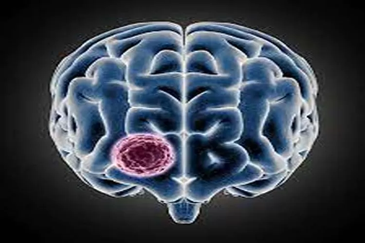 Ini Gejala Tumor Otak Yang Harus Diwaspadai Sejak Dini  (Isti)
