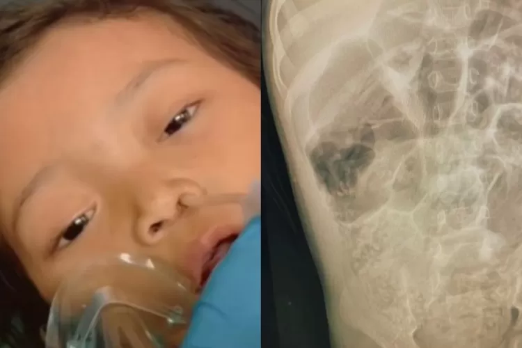  Raya, balita malang yang meninggal dengan kondisi dipenuhi cacing gelang (Foto: instagram / @rumah_teduh_sahabat_iin)