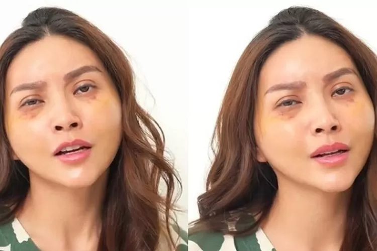 Penampilan Sarwendah Usai Menjalankan Operasi Plastik di Korea Selatan (Topmedia.co.id / Istimewa)