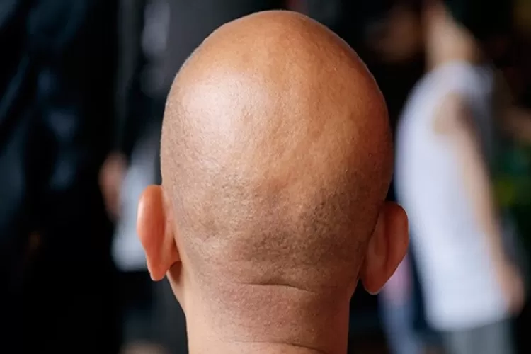 Ilustrasi Pria Alami Kerontokan Rambut Sehingga Menyebabkan Kebotakan (TOPmedia.co.id / Ilustrasi)