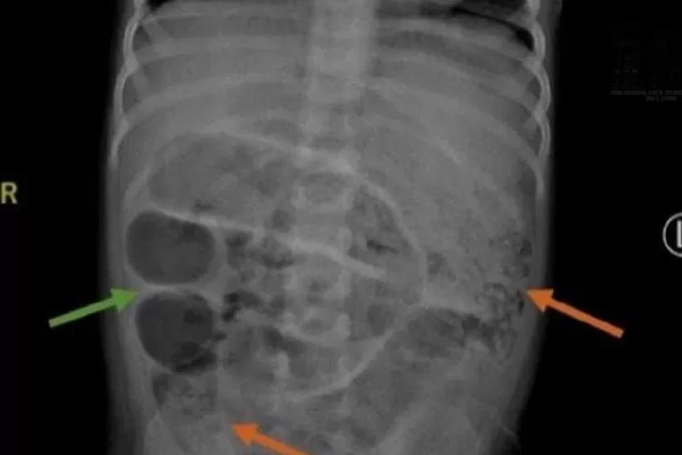Hasil Rontgen Anak yang di Perutnya Terdapat Cacing Pita. (instagram.com/jemberinfo_)