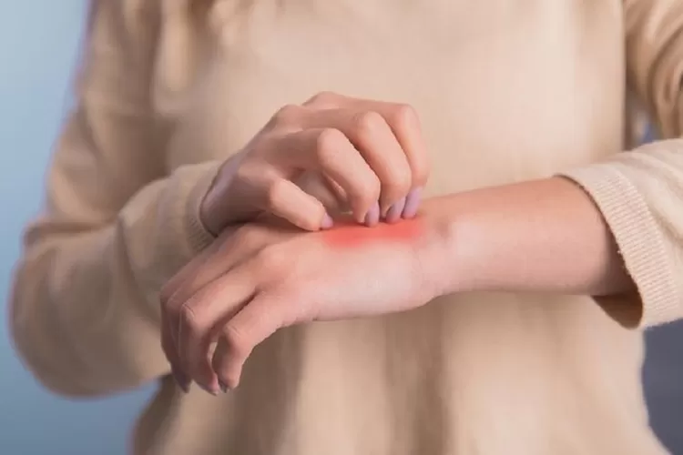 Ilustrasi alergi. ( (Foto: Getty Images/iStockphoto/Daniel Tadevosyan))