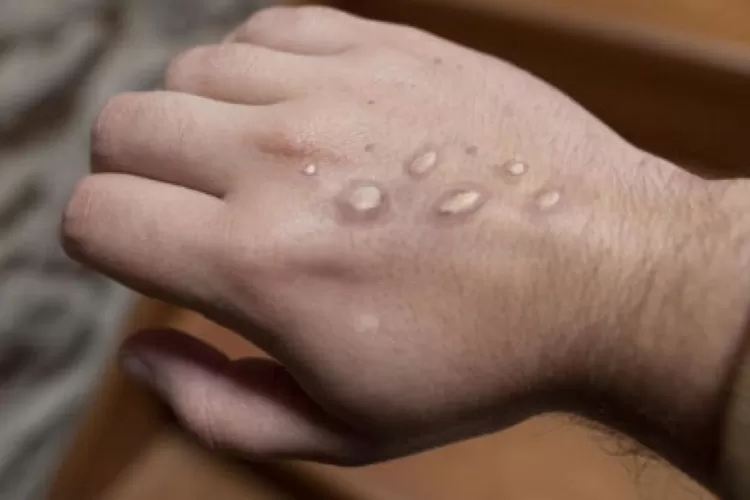 Virus cacar monyet (X tangsel)