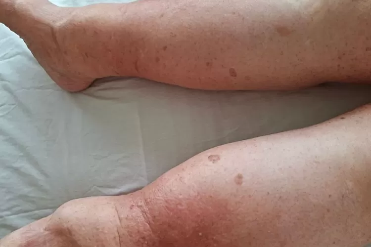 Pemuda di Tangerang Derita Limfedema, Kakinya Membengkak hingga 50 Kg (Instagram @espacodamisslene)