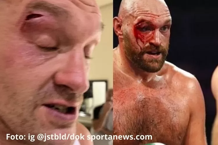 Tyson Fury cedera, duel ditunda.