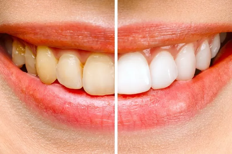 Potret ilustrasi gigi kuning dan gigi putih alami
