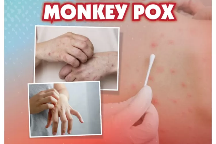 Cacar Monyet sebuah penyakit menular yang mulai menjadi sorotan di Jakarta (dok semarangkota.go.id)