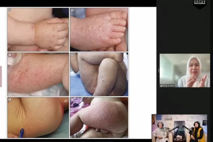 Dokter Spesialis Anak Rumah Sakit Cipto Mangunkusumo (RSCM) dr. Nina Dwi Putri, Sp.A(k), M.Sc mempresentasikan ruam HFMD dalam diskusi daring bertajuk &ldquo;Mengupas mitos dan fakta terkait Hand, Foot and Mouth Disease (HFMD)&rdquo; bersama Puskesmas Kramat Jati, Kamis (28/3/2024).  (ANTARA/Tangkapan layar)