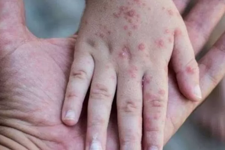 Musim Flu dan Radang Tenggorokan, Apakah Kalian Terjangkit Flu Singapura? Kenali Ciri-cirinya Disini  (GenzDaily/dok: website Primaya Hospital )