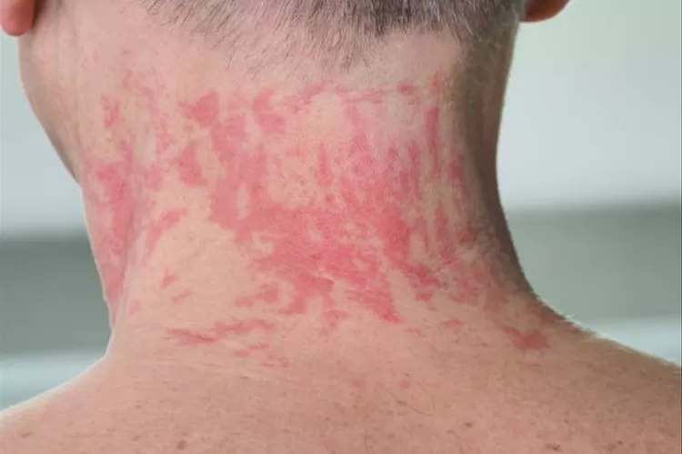 Kenali 7 pantangan utama bagi penderita cacar ular untuk mempercepat pemulihan efektif. (Pixabay / HukamaNews.com)