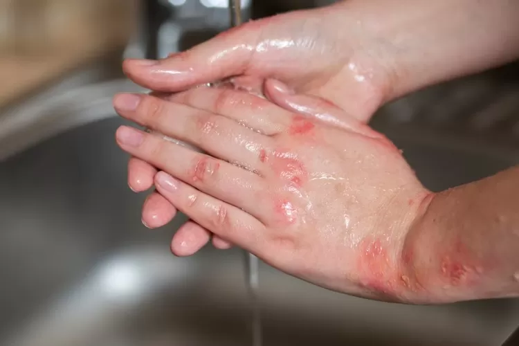 Ilustrasi cacar air  (Freepik)