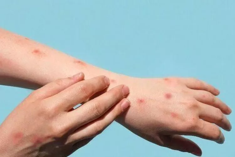 Virus monkeypox atau cacar monyet kini sudah mulai terdapat di kota Cirebon. (Instagram/@kemenkes_ri)