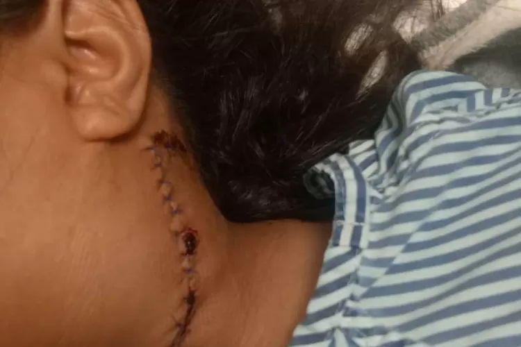 Ibu yang lehernya terkena peluru di Labuan Bajo sudah operasi di salah satu rumah sakit di Denpasar. (Foto diterima dari Gordianus, anggota keluarga.)