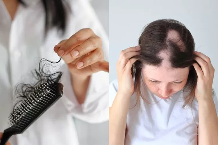 Ilustrasi Rambut Rontok 