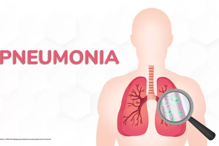 Ilustrasi pneumonia  (Istimewa )