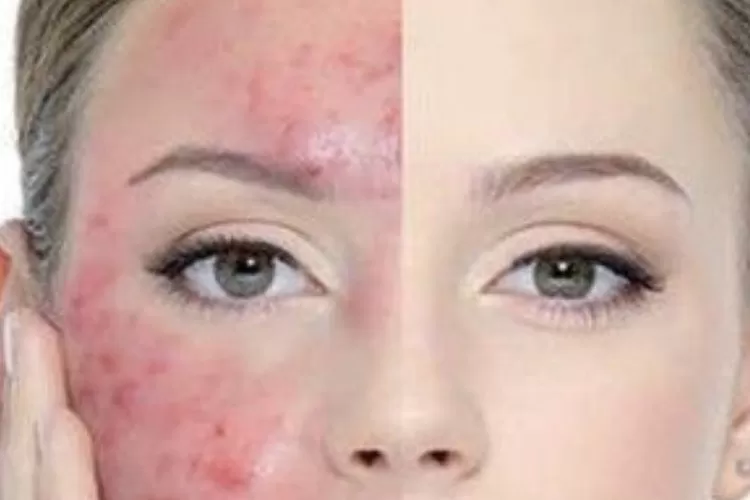 Pemilik Kulit Sensitif Harus Tahu! Inilah Cara Pakai Skincare Siang ...