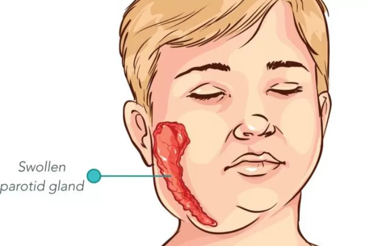 pembengkakan kelenjar ludah pada anak-anak (PIXABAYcorbac40)