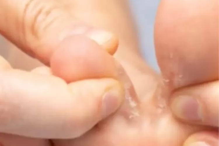 Apa itu kutu air pada kaki?  (Youtobe@kuncisehat.com)