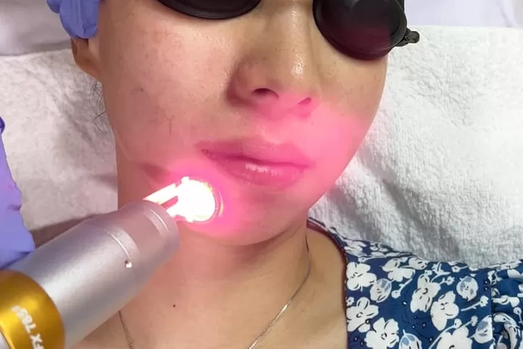 Buka cabang di Tangsel, Carla Skin Clinic Hadirkan Treatment andalan Pico Laser dan Exosome (Tebe/Indonesiadaily.co.id)