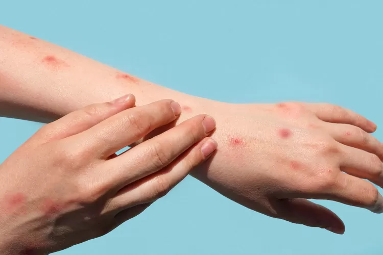 Ilustrasi Mpox atau Cacar Monyet atau Mpox (rspondokindah.co.id)