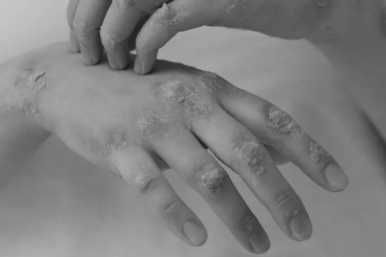 Ilustrasi Cacar monyet. (Freepik)