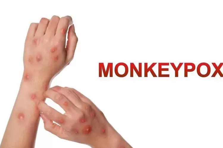 Virus Mpox atau cacar monyet. (ist)