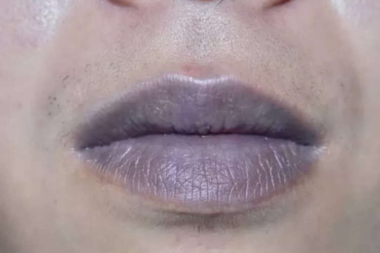 Bibir hitam (Istimewa/net)