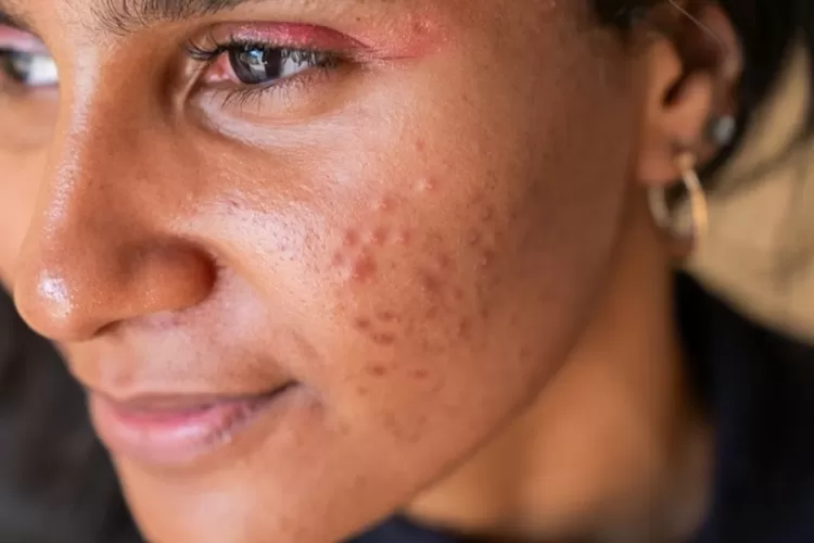 Ilustrasi Kondisi wajah berminyak dan berjerawat  (Foto/Ilustrasi @unsplash )